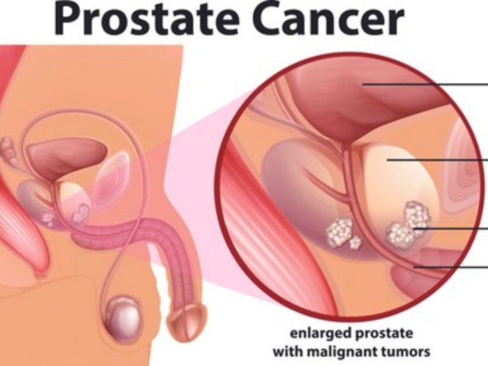 Informasi Tentang Penyakit Kanker Prostat (Prostate Cancer)