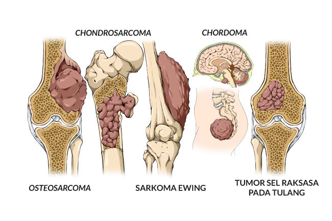 Informasi Tentang Penyakit Kanker Tulang (Sarkoma Tulang)